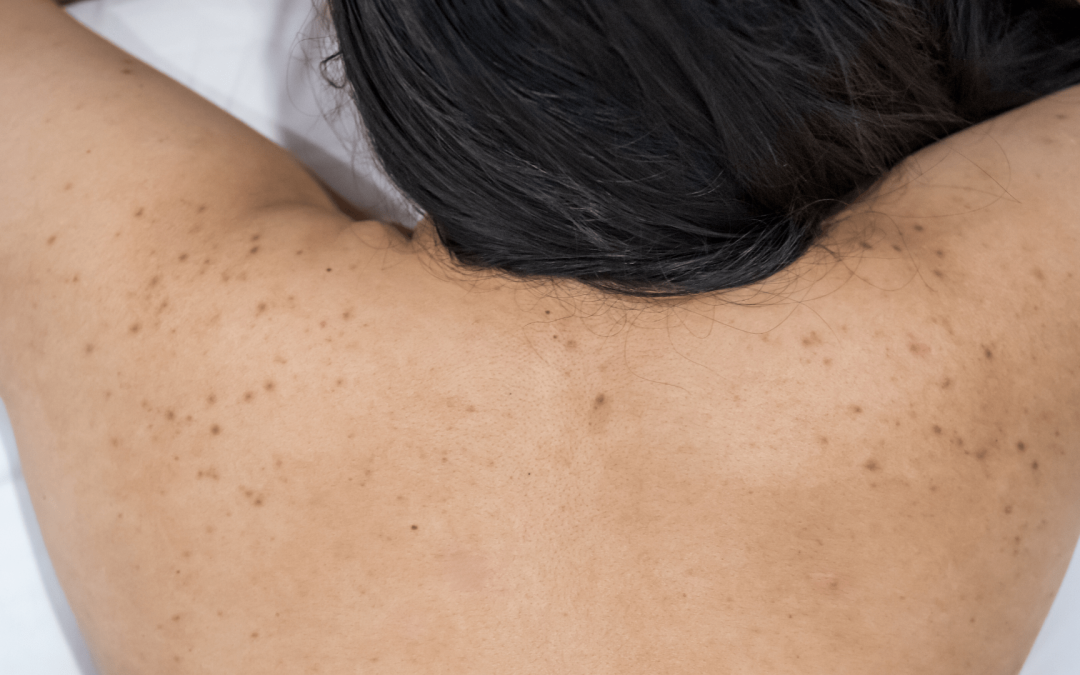 Les changements de la peau pendant la péri-ménopause